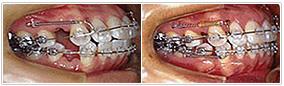 orthodontic-treatment11