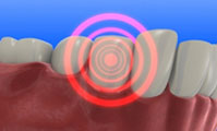 periodontaldisease1